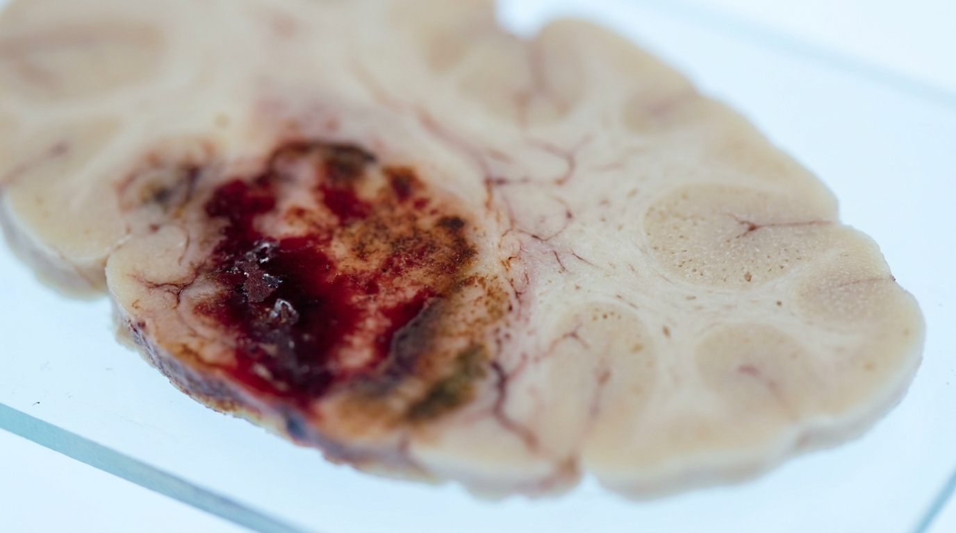 Auricular Vagus Nerve Stimulation Manages Refractory Sympathetic Hyperactivity Post-Hemorrhage