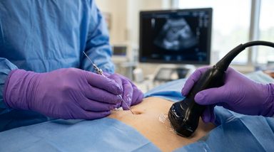 Percutaneous Cryoablation Reduces Pain and Volume in Umbilical Endometriosis