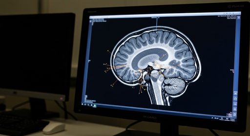 Baseline Connectivity Predicts Anxiety Improvement in Prefrontal TMS Trial
